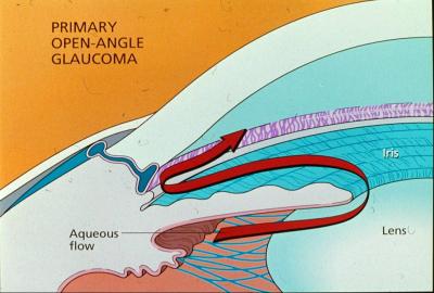 Glaucoma de Ángulo abierto