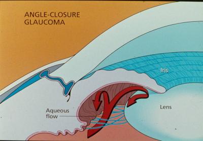 Glaucoma de Ángulo cerrado